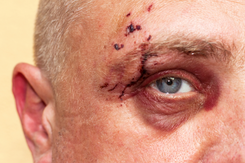 Common Injuries from Dog Bites and Their Treatment