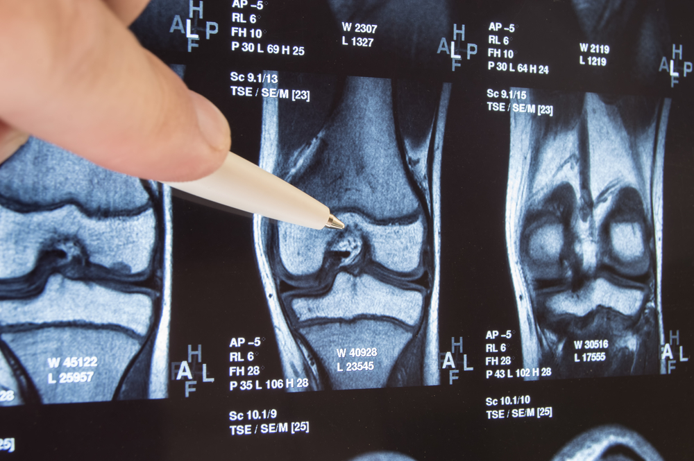 How to File a Defective Medical Device Lawsuit